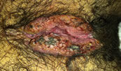 Tratamiento de tumoración anal en Chilpancingo